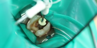 Wurzelkanalbehandlungen