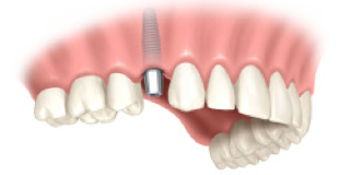 Implantate